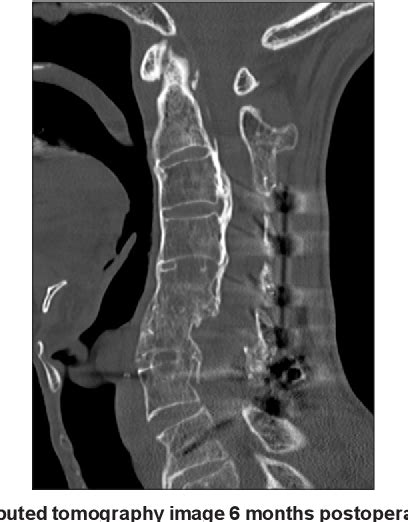 Figure 3 From Cervical Spinal Fracture In A Patient With Diffuse