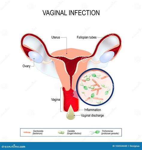 Infec O Vaginal E Agentes Causais Do Vulvovaginitis Ilustra O Do