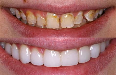 Veneers Before And After Photos Newmouth