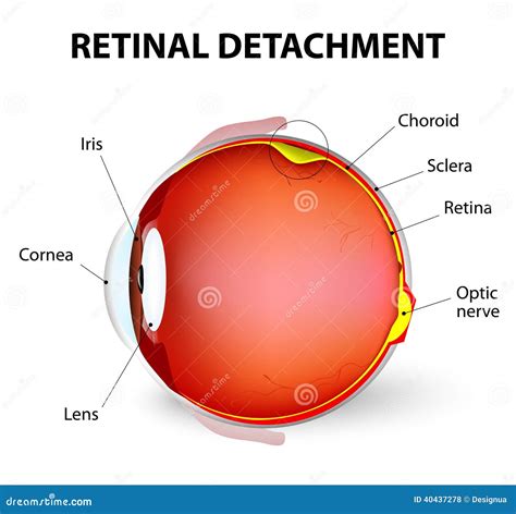 Retinal Detachment Vector Diagram Stock Vector Illustration Of