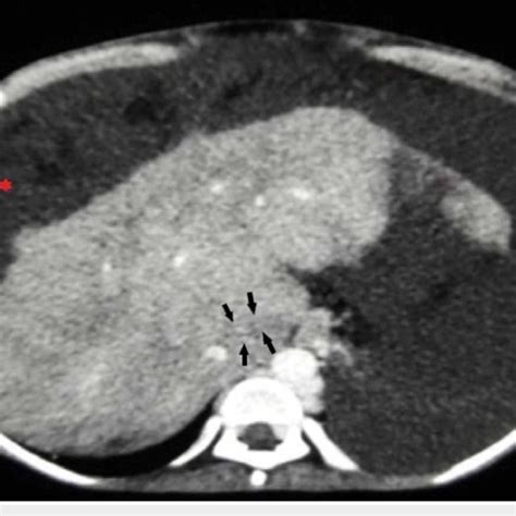 Axial Contrast Computed Tomography Ct Obtained During Venous Portal