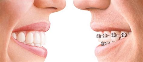 Invisalign Vs Braces How They Compare And What You Need To Know