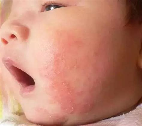 湿疹，是婴幼儿时期常见的皮肤病，也称特应性皮炎。过敏湿疹宝宝新浪网