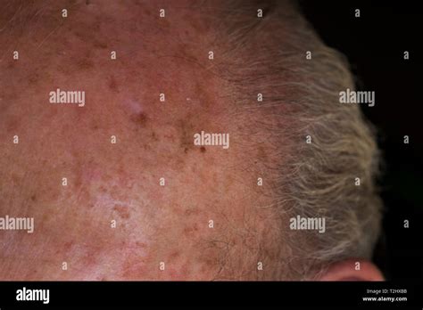 Carcinoma Melanoma Skin Damage On Elderly Mans Forehead From Sun