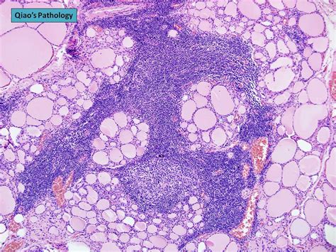 Qiaos Pathology Chronic Lymphocytic Thyroiditis Hashimo Flickr