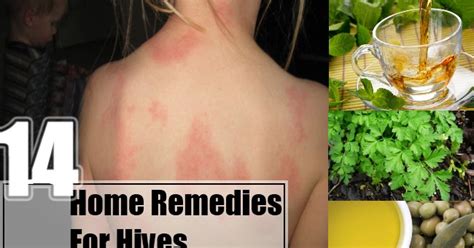 Top 14 Home Remedy For Hives Natural Remedies And Treatment