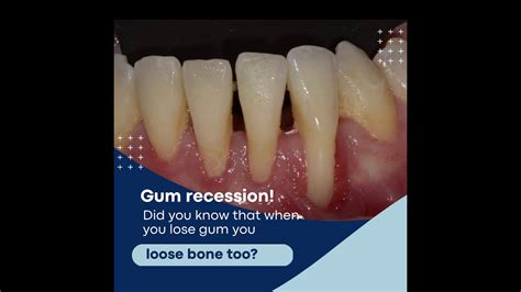 Gum Recession Youtube