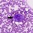 A Cluster Of Epithelioid Histiocytes Black Arrow With Nucleomegaly 
