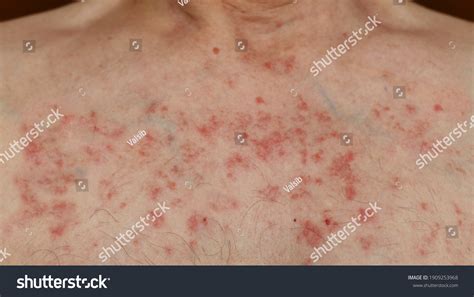 599 Rash Chest Stock Photos Images And Photography Shutterstock