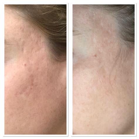 Acne Acne Scar Progress After 1 Microneedling Session R