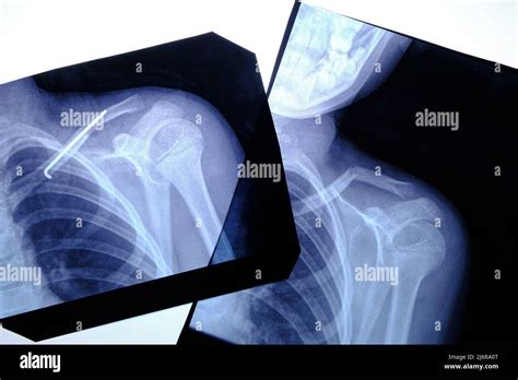 Two X Ray Images Man With Fractured Collarbone And An Inserted Space