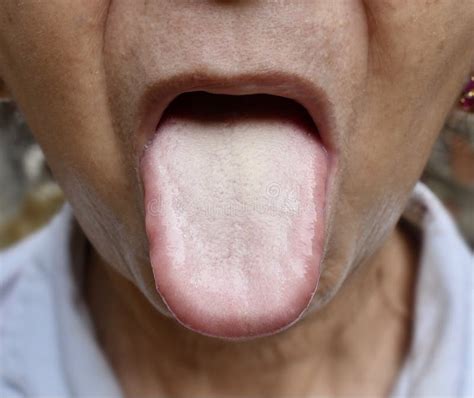 Coated Tongue Or White Tongue Loss Of Taste Called Ageusia Stock Image