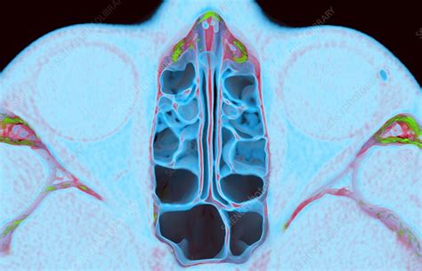 Paranasal Sinuses 3d Ct Scan Stock Image C0492681 Science Photo