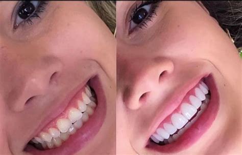 Carillas de Porcelana vs Composite Clínica dental en Guatemala