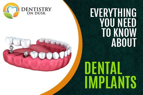 Everything You Need To Know About Dental Implants Dentistryondusk