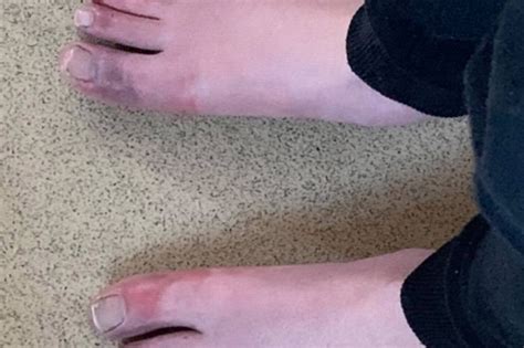 Mums Warning To Parents Over Covid Toes After Sons Feet Swelled And