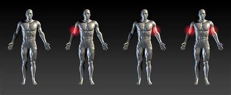 Torn Biceps Tendon Symptoms Causes Risk Factors