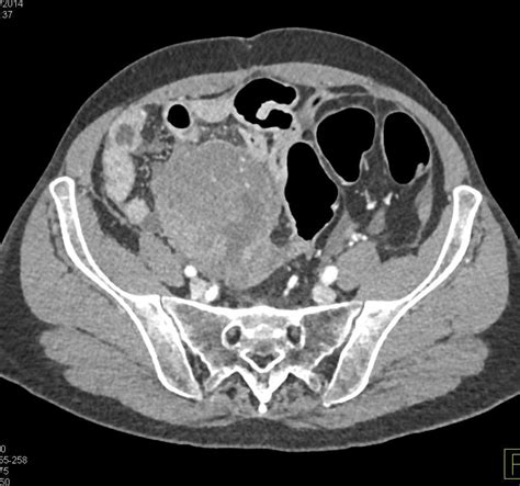 Carcinomatosis With Partial Small Bowel Obstruction Small Bowel Case