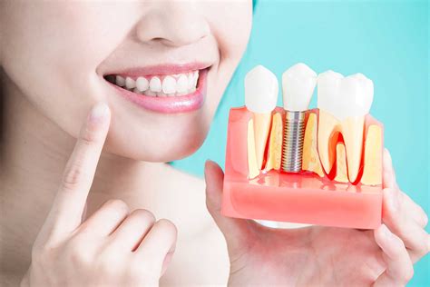 Implantes Dentales Md Odontologia