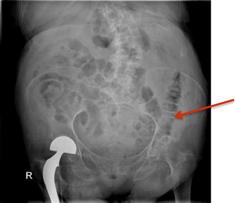 Bilateral Saccular Inguinal Hernias In An Elderly Woman Presenting With