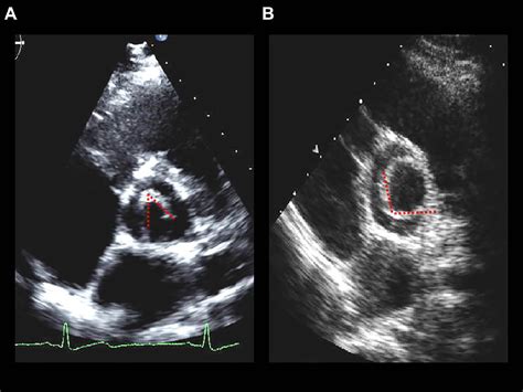 Diagnostic Accuracy Of Echocardiography And Intraoperative Surgical
