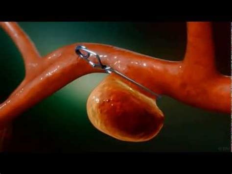 Aneurysm Clipping Surgery Animation