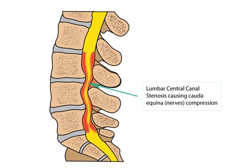 Cervical Central Canal Stenosis Jlynedesigns Free Hot Nude Porn Pic