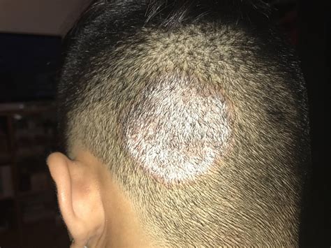 Fungal Infection On Scalp Ringworm Psoriasis X Post Rdermatology