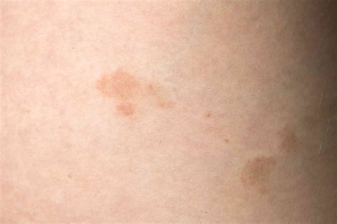 Pictures Of Dry Skin Patches On Back Goimages Base