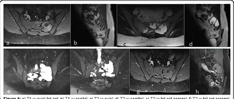 Figure 1 From Huge Aneurysmal Bone Cyst Of The Sacrum A Case Report