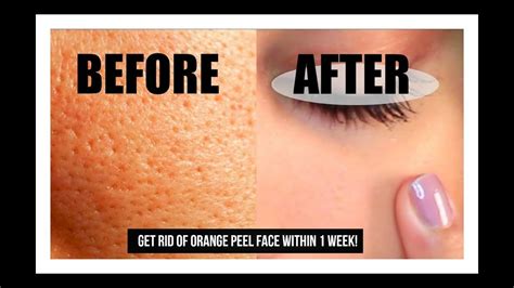 How To Get Rid Of Orange Peel Skin Youtube