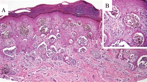 A Nests Of Melanocytes Restricted To Dermoepidermal Junction And