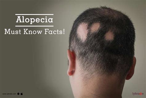 Alopecia Must Know Facts By Dr Gajanan Anand Jadhao Lybrate