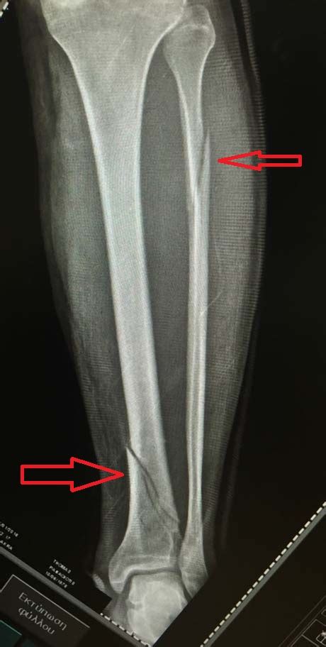 Treatment of lower leg fractures can vary depending on the severity of the fracture. TIBIAL FRACTURE | GEORGE D. GOUDELIS MD. Ph.D.