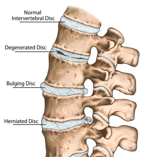 Disc Bulge Herniation Portland Physical Therapy