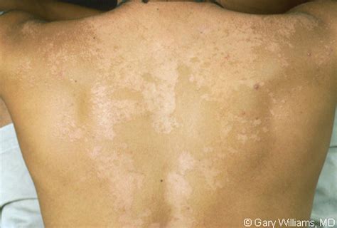 Pityriasis Versicolor Treatment Pictures Photos