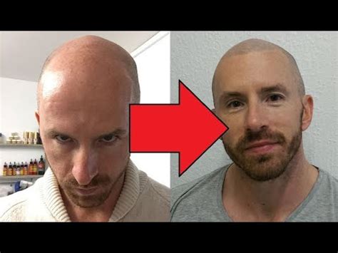 Hidden Clues in Micro Hair Pigmentation Before and After ...
