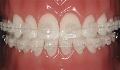 Clear Braces Stained