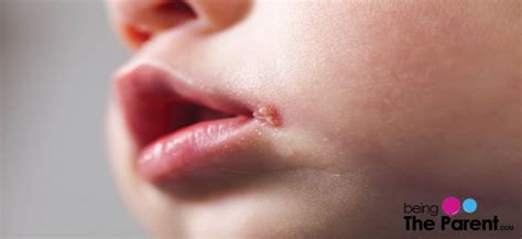 Warts In Babies Everything You Need To Know Being The Parent