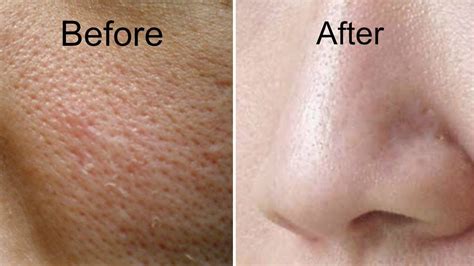 How To Get Rid Of Large Pores In 3 Days Get Smooth Fairer And
