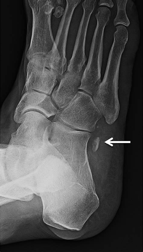Oblique Radiograph Of The Right Foot From May 2016 After An Acute Ankle