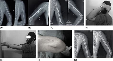 Functional Outcome Of Extra Articular Distal Humerus Fracture Fixation Using A Single Locking