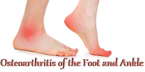 Osteoarthritis Of The Ankle What Is Osteoarthritis Osteoarthritis By Christy Smith