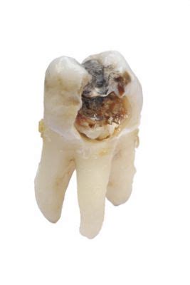 Ein kariöser zahn wird normalerweise mit einer füllung behandelt. Was tun bei Löchern in den Zähnen? Karies, Parodontose und ...
