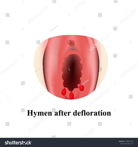 Structure Vulva Hymen Hymenoplasty Hymen After Stok Vektör Telifsiz