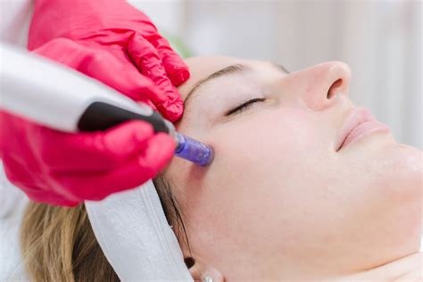 Micro Needling Skin Rejuvenation Skinpen In San Antonio Tx