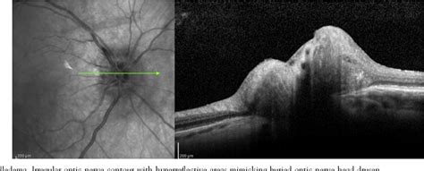 Figure 1 From Differentiating Mild Papilledema And Buried Optic Nerve