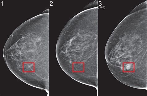 These Doctors Are Using Ai To Screen For Breast Cancer Wired