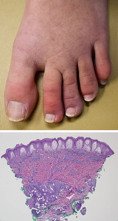 Symptoms Discolored Toes