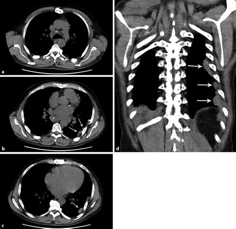 Axial Non Contrast Enhanced Ct Images In A Mediastinal Window Setting